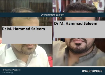 FUE clinical comparison from Dr Hammad Aesthetic — case 04