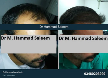 FUE clinical comparison from Dr Hammad Aesthetic — case 05