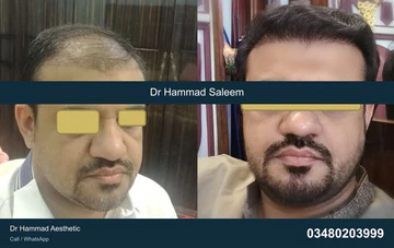 FUE clinical comparison from Dr Hammad Aesthetic — case 06