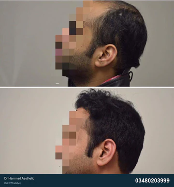 FUE clinical comparison from Dr Hammad Aesthetic — case 07