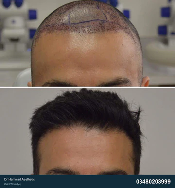 FUE clinical comparison from Dr Hammad Aesthetic — case 08