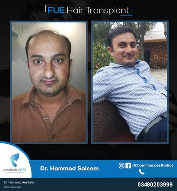 FUE clinical comparison from Dr Hammad Aesthetic — case 09