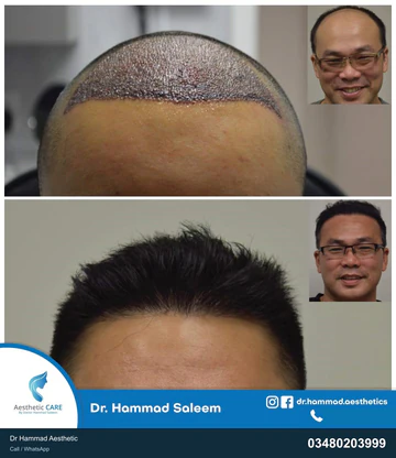 FUE clinical comparison from Dr Hammad Aesthetic — case 10