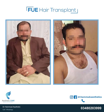 FUE clinical comparison from Dr Hammad Aesthetic — case 11