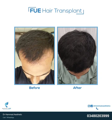 FUE clinical comparison from Dr Hammad Aesthetic — case 12