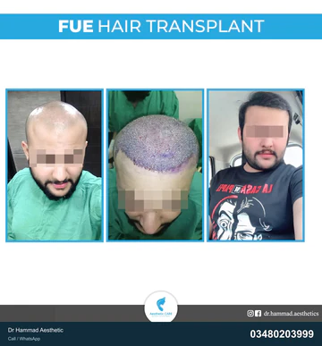 FUE clinical comparison from Dr Hammad Aesthetic — case 13