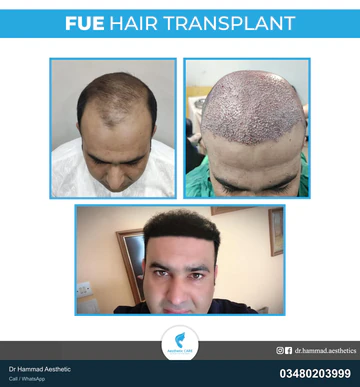 FUE clinical comparison from Dr Hammad Aesthetic — case 14