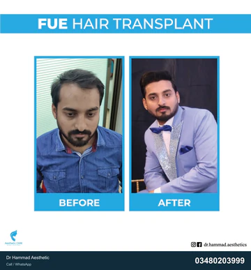 FUE clinical comparison from Dr Hammad Aesthetic — case 15