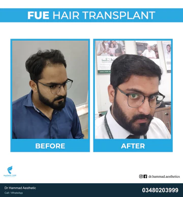 FUE clinical comparison from Dr Hammad Aesthetic — case 16