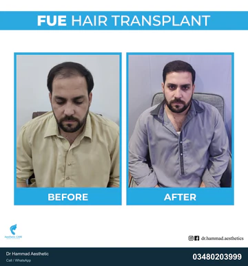 FUE clinical comparison from Dr Hammad Aesthetic — case 17