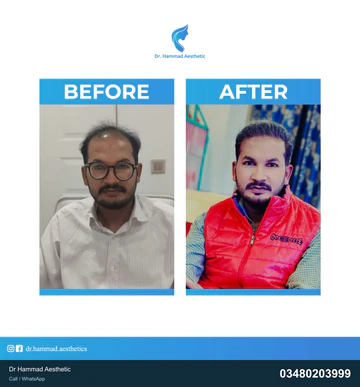 FUE clinical comparison from Dr Hammad Aesthetic — case 18