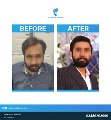 FUE clinical comparison from Dr Hammad Aesthetic — case 19