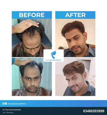 FUE clinical comparison from Dr Hammad Aesthetic — case 20