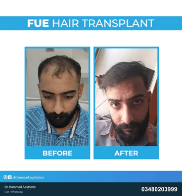 FUE clinical comparison from Dr Hammad Aesthetic — case 21