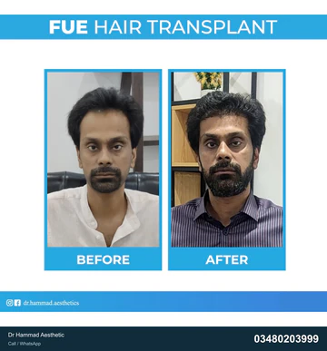FUE clinical comparison from Dr Hammad Aesthetic — case 22