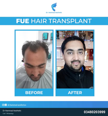 FUE clinical comparison from Dr Hammad Aesthetic — case 23