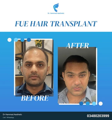 FUE clinical comparison from Dr Hammad Aesthetic — case 24