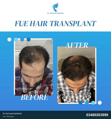 FUE clinical comparison from Dr Hammad Aesthetic — case 25