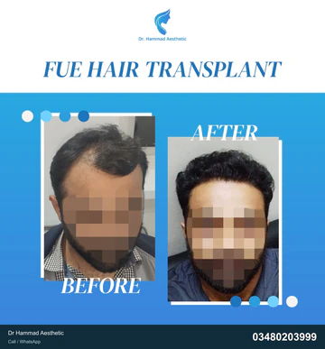 FUE clinical comparison from Dr Hammad Aesthetic — case 26