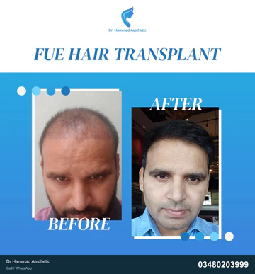 FUE clinical comparison from Dr Hammad Aesthetic — case 27