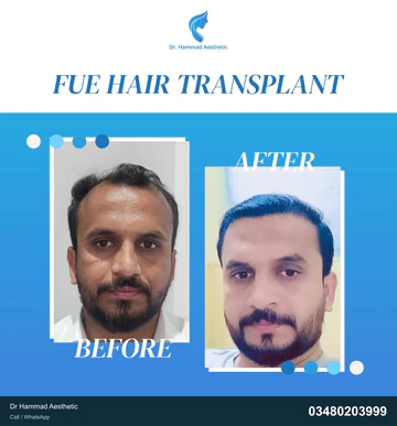 FUE clinical comparison from Dr Hammad Aesthetic — case 28