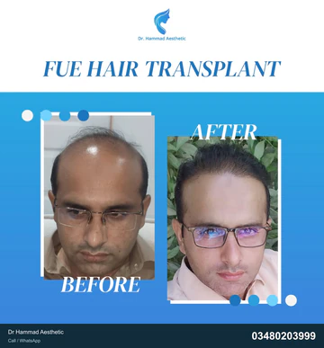 FUE clinical comparison from Dr Hammad Aesthetic — case 29