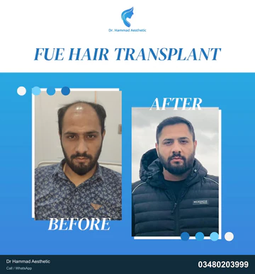 FUE clinical comparison from Dr Hammad Aesthetic — case 30