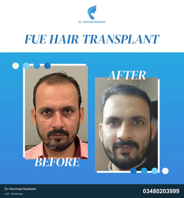 FUE clinical comparison from Dr Hammad Aesthetic — case 31