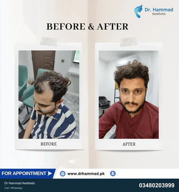 FUE clinical comparison from Dr Hammad Aesthetic — case 32
