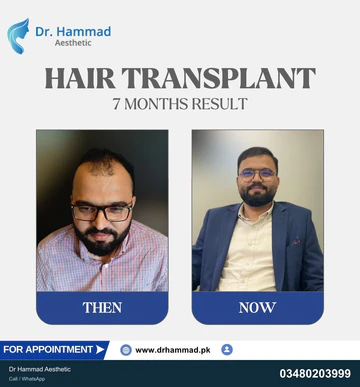 FUE clinical comparison from Dr Hammad Aesthetic — case 33
