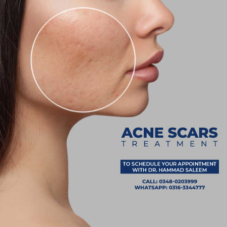Acne Scare Treatment